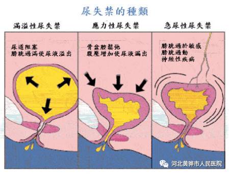 “国际尿失禁周”公益讲座加义诊—关注尿失禁，关爱女性泌尿健康
